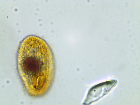 Glaucoma scintillans #35462