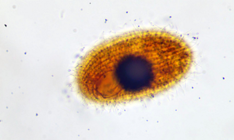 Glaucoma scintillans #35522