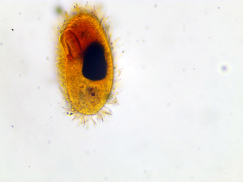 Glaucoma scintillans #35524