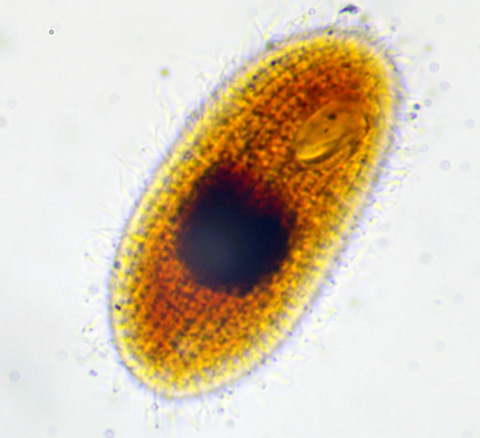 Glaucoma scintillans #35523