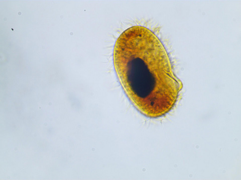 Glaucoma scintillans #35461