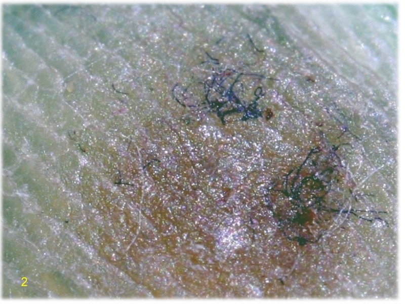 Virus : verrue plantaire... #30427
